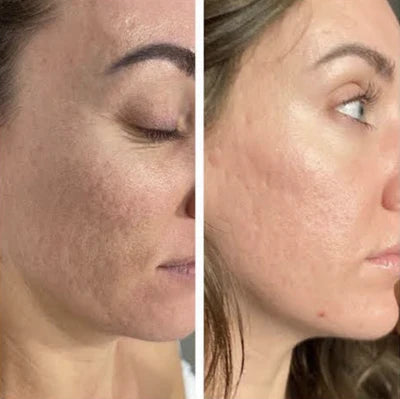 Before and after RF microneedling result 4